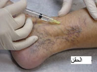 Varicose Veins