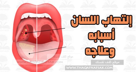 التهاب-اللسان-وعلاجه