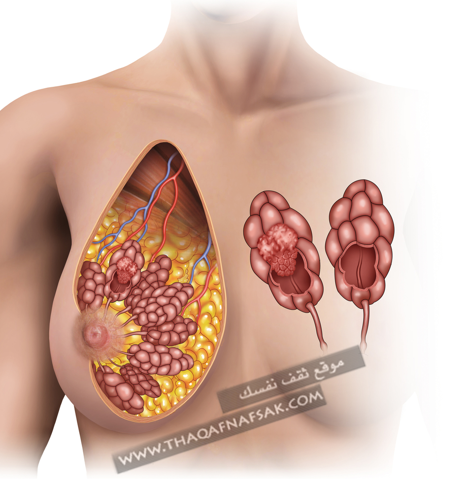 تورم-حلمة-الثدي