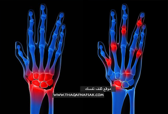 علاج-التهاب-مفاصل-اليدين