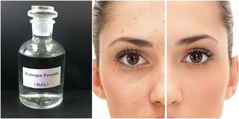 Oxygen water for acne