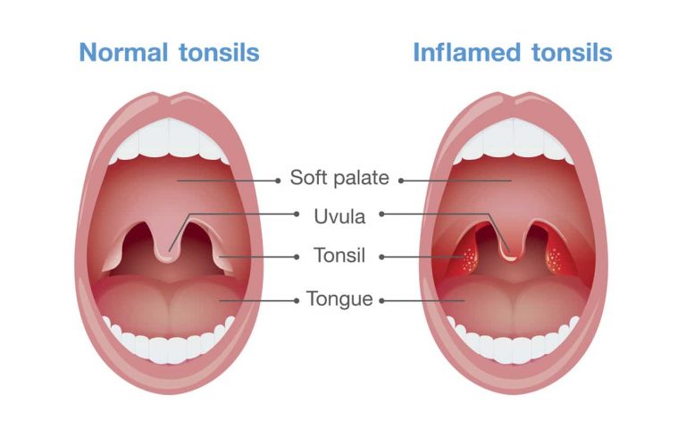 التهاب اللوزتين