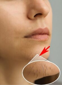 شعر الذقن عند النساء وداعاً للإحراج