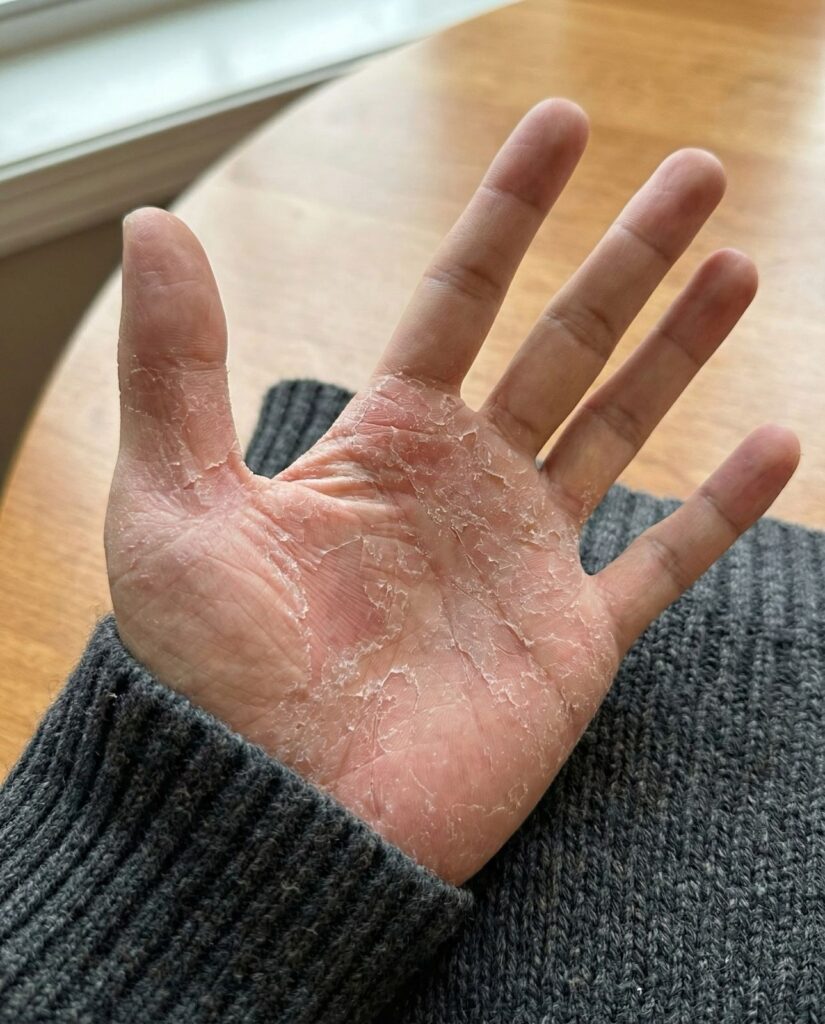 تقشر جلد اليدين احذر هذه العلامات على يدك