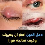 دمل جفن العين