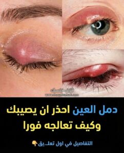 دمل جفن العين