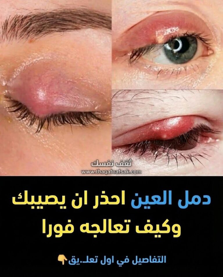 دمل جفن العين