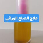 الصلع الوراثي