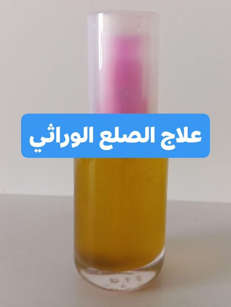 الصلع الوراثي