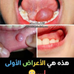 أسباب وعلاج الحبوب على اللثة والشفايف واللسان