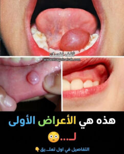 أسباب وعلاج الحبوب على اللثة والشفايف واللسان