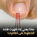 الخطوط على الأظافر، أنواعها، ودلالاتها الصحية،