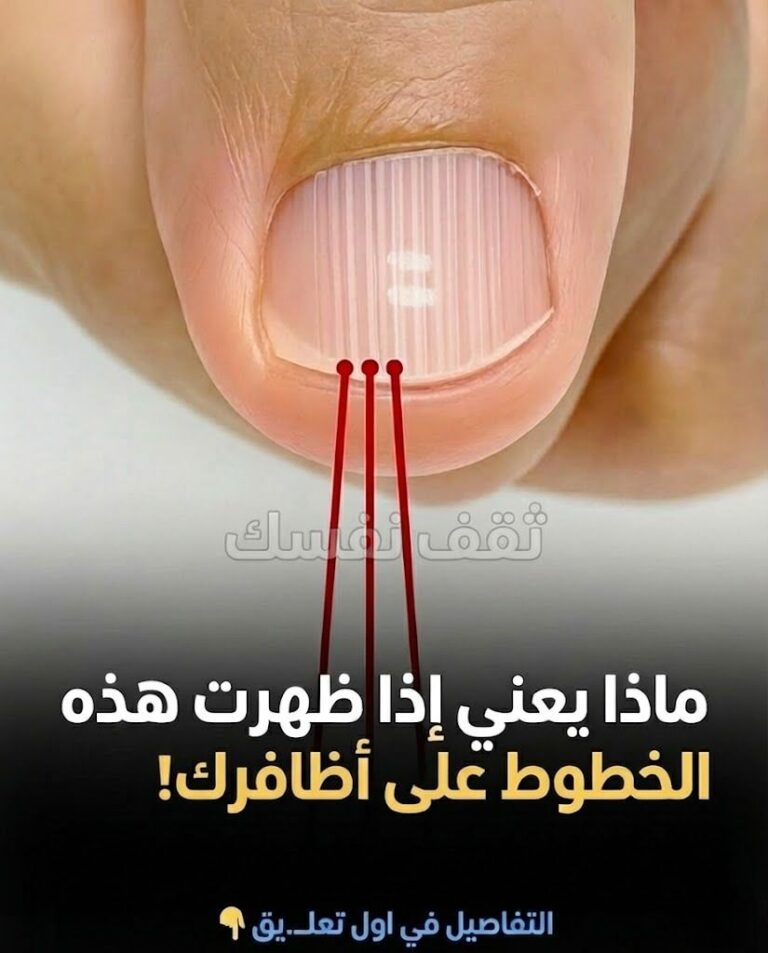 الخطوط على الأظافر، أنواعها، ودلالاتها الصحية،