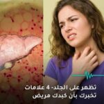 إجهاد الكبد