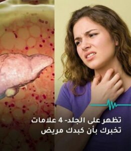 إجهاد الكبد