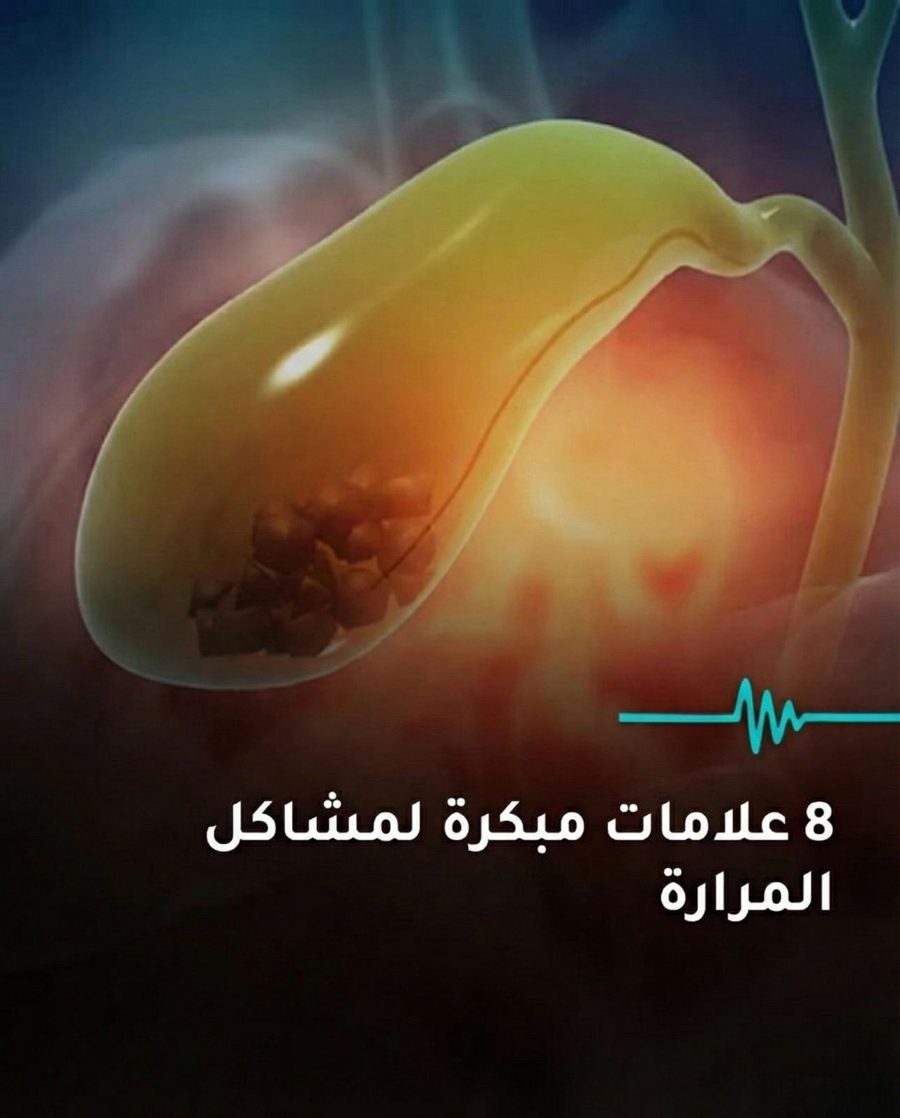 مشكلة في المرارة