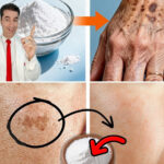removing skin blemishes