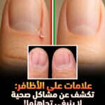 علامات الأظافر