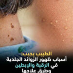 الزوائد الجلدية في الرقبة والإبطين