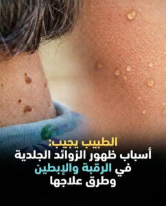 الزوائد الجلدية في الرقبة والإبطين