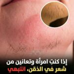 شعر الذقن عند البنات