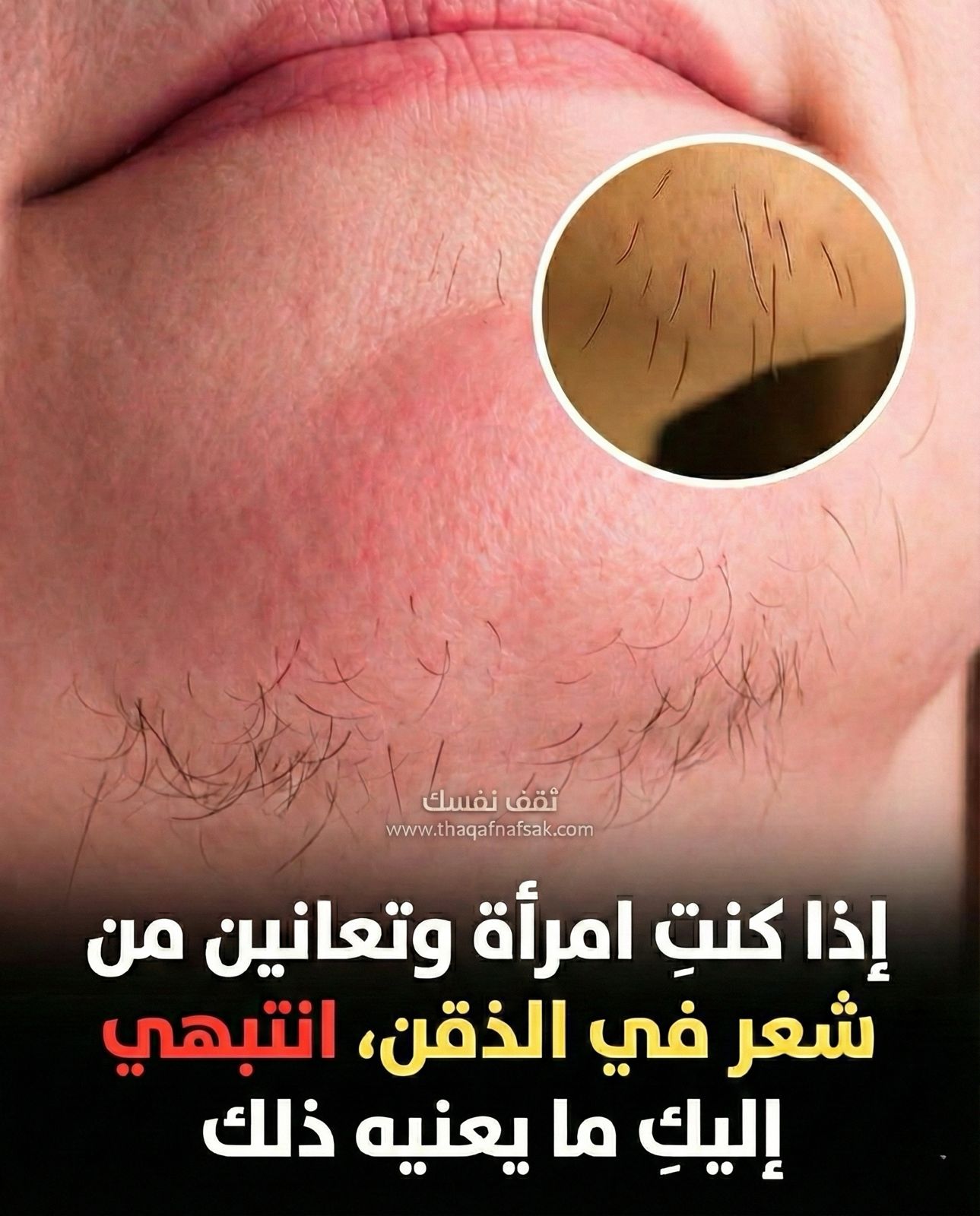 شعر الذقن عند البنات