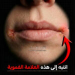 التهاب الشفة الزاوي