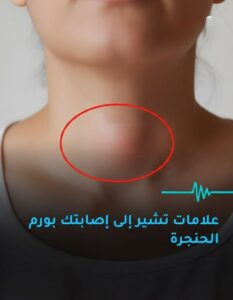 علامات الاصابة بورم الحنجرة