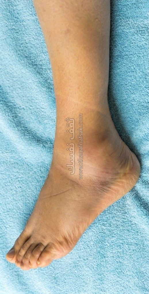 أسباب تورم الكاحلين