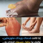 تورم القدمين واليدين على ماذا يدل
