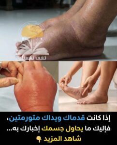 تورم القدمين واليدين على ماذا يدل