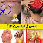 نقص فيتامين B12