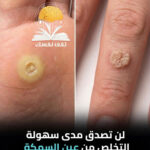 عين السمكة طبيعيا تخلص منها الأن