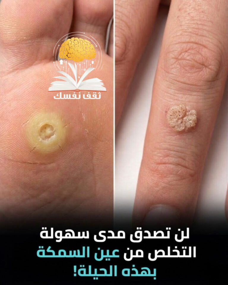 عين السمكة طبيعيا تخلص منها الأن