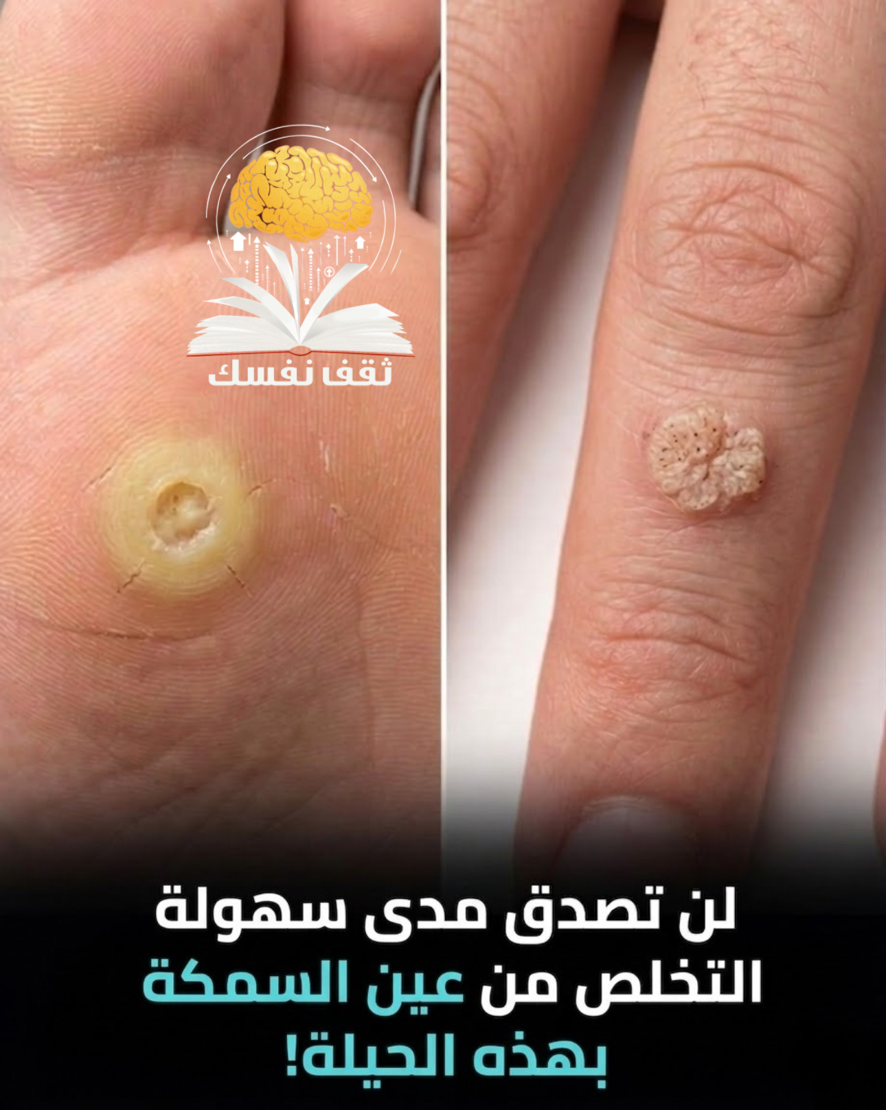 عين السمكة طبيعيا تخلص منها الأن