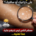 هل لاحظت بقع بيضاء على الذراع والساق ... ولا تعرف ما هي؟