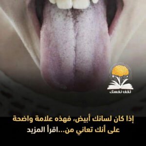 اللسان الأبيض ماذا يخبرنا ؟ بين الصحة والمرض