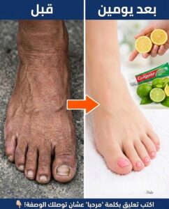 كيف حسّنت مظهر ساقيَّ وجعلتها أكثر بياض ؟ تبييض الساق